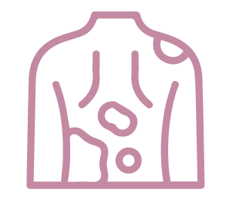 dermatología clínica vitiligio